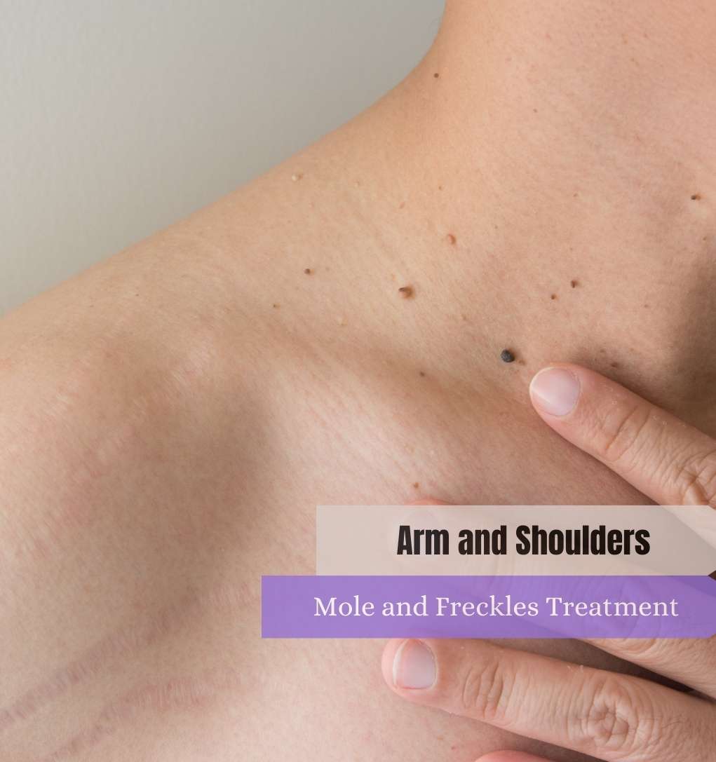 Arm and Shoulders