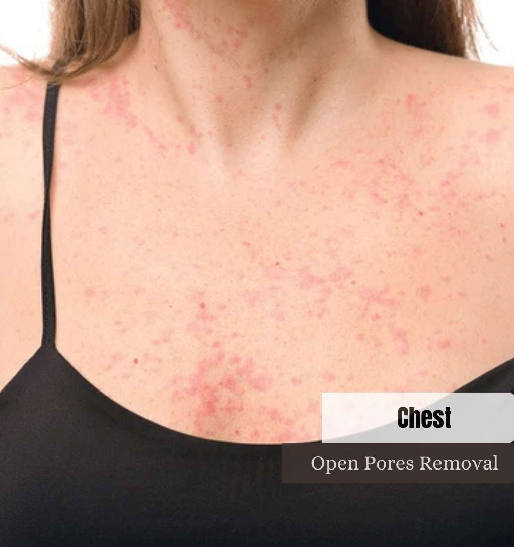 Chest Open Pores