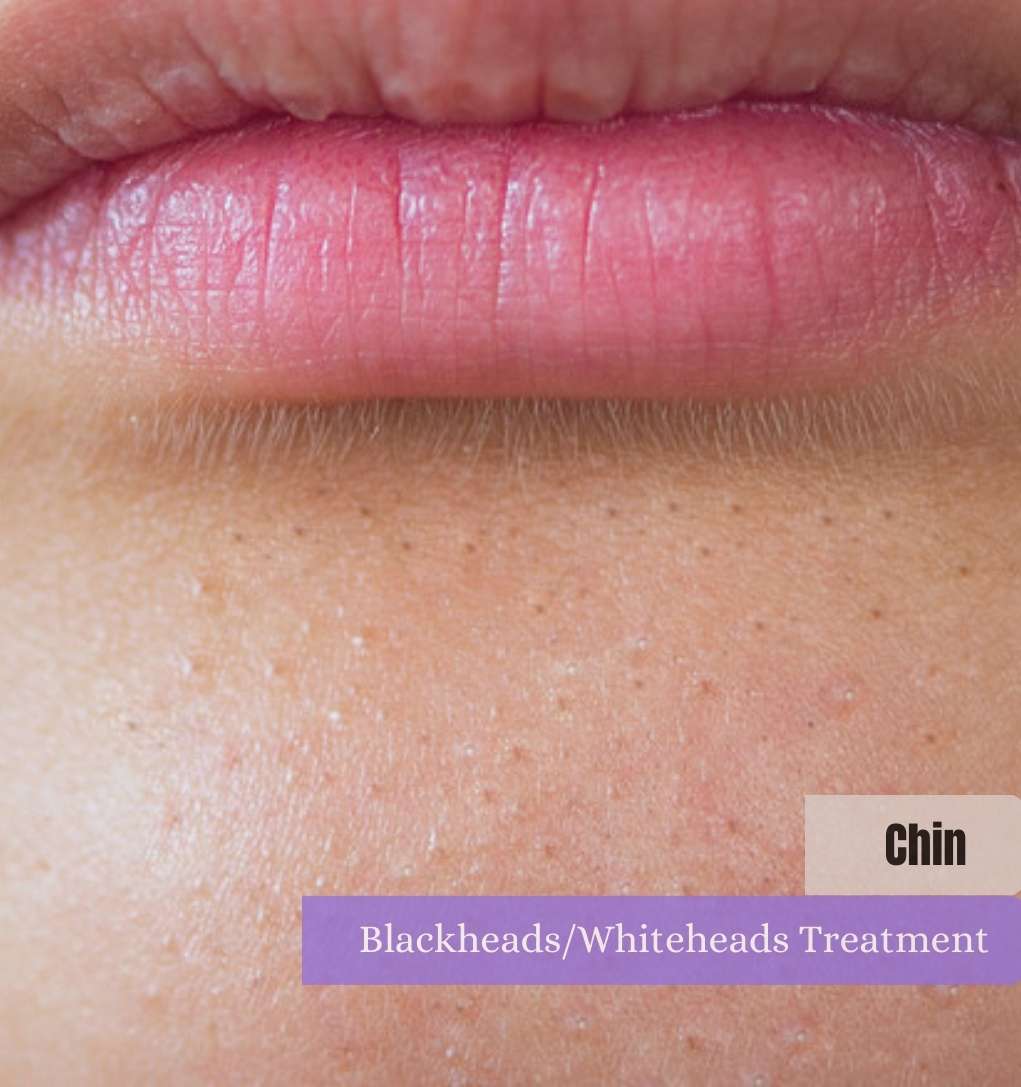 Chin blackheads