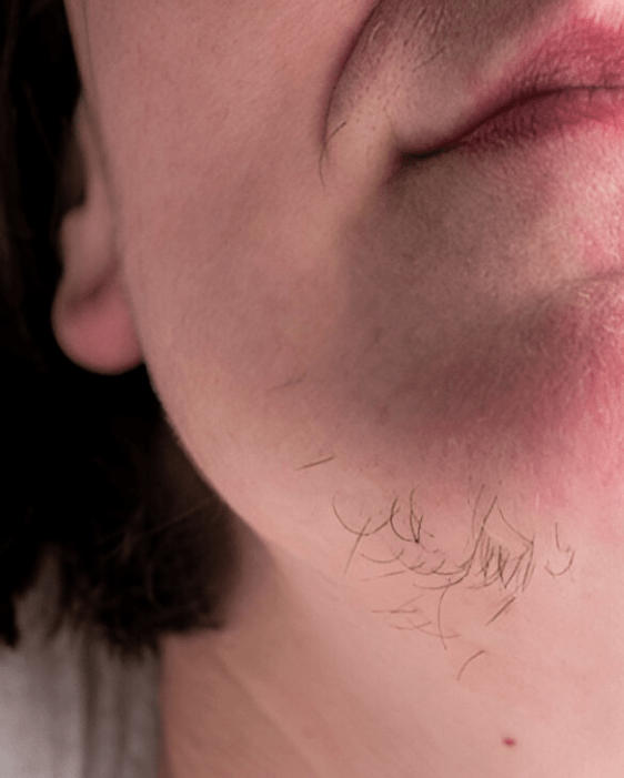 Laser hair removal (5) Laser hair removal (5)