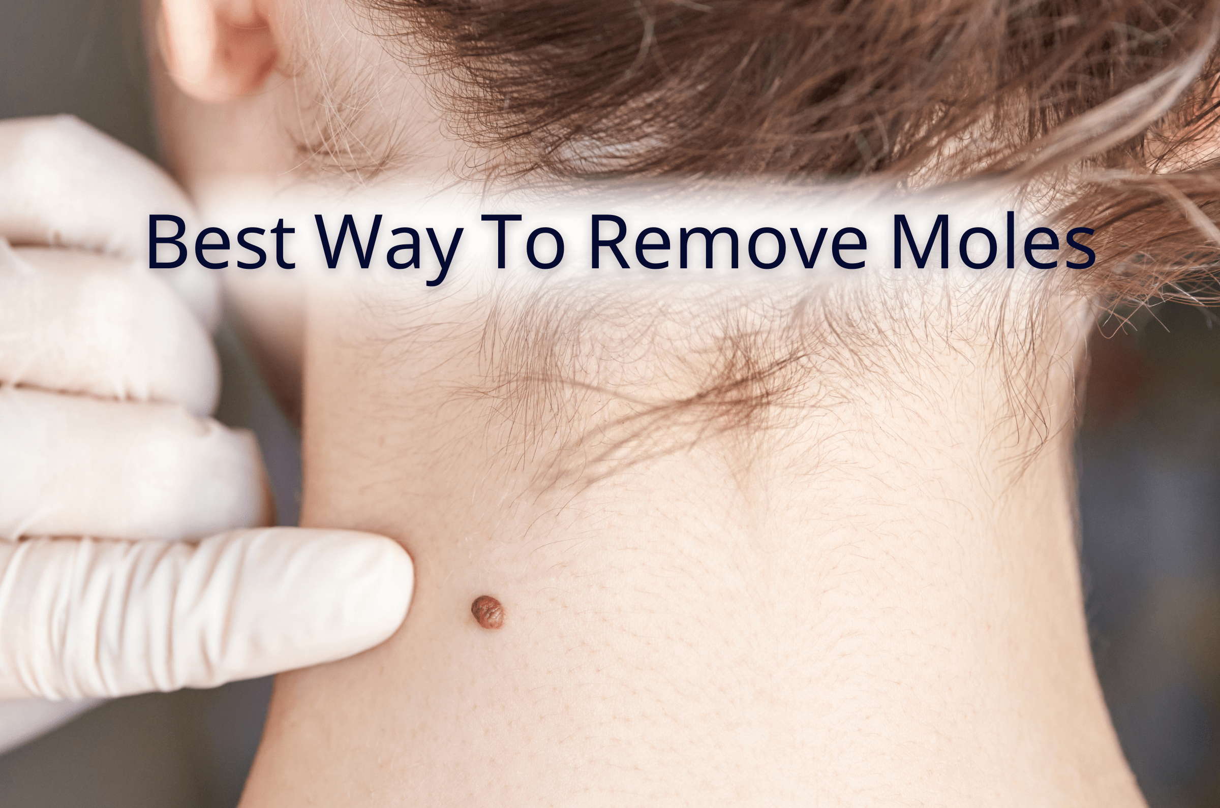 Mole Removal : Best Way To Remove Moles