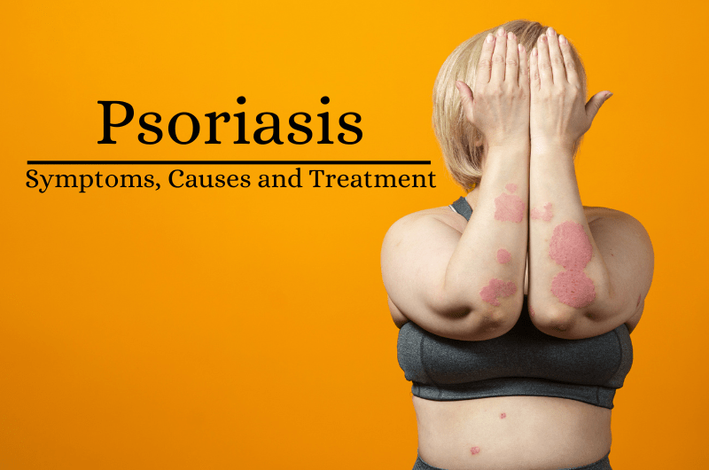 Psoriasis: Symptoms, Causes, and Treatment