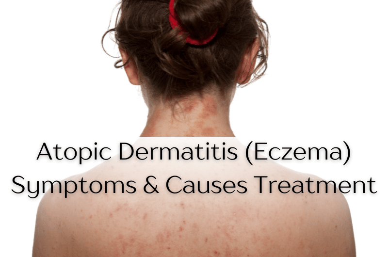 Atopic Dermatitis (Eczema): Symptoms, Causes & Treatment