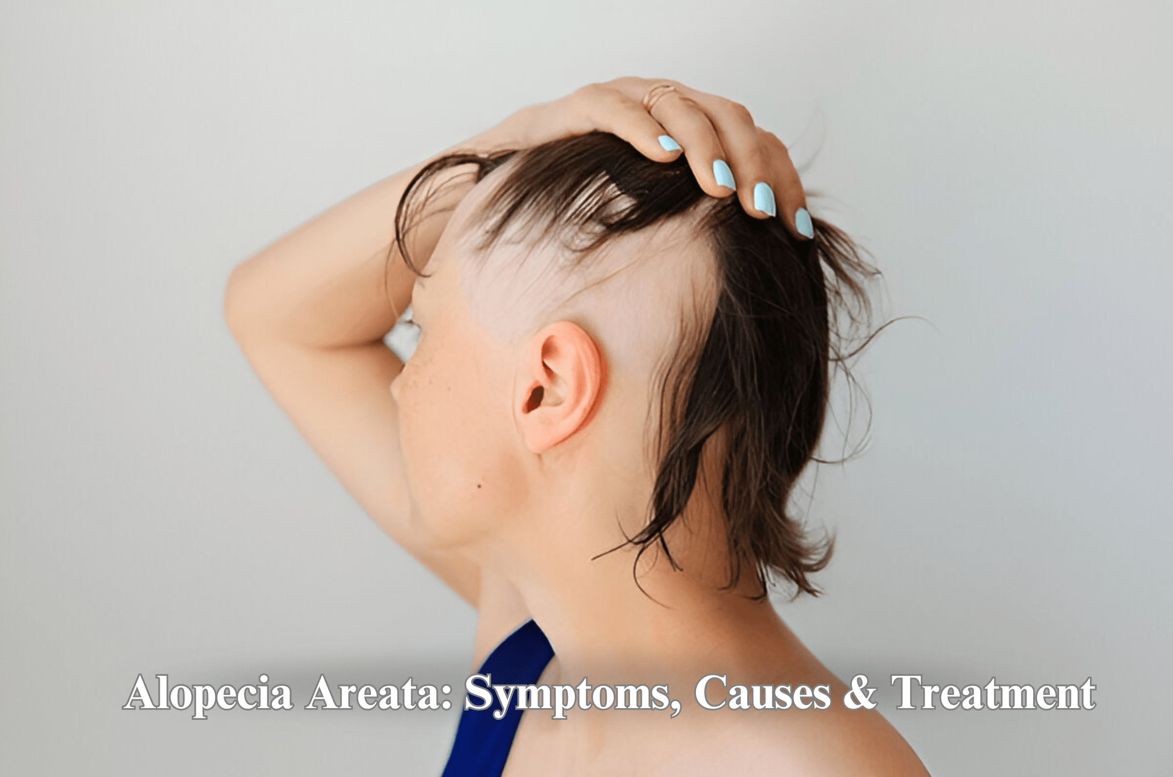 Alopecia Areata Treatment: Causes &  Symptoms
