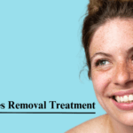 Freckles Removal Treatment