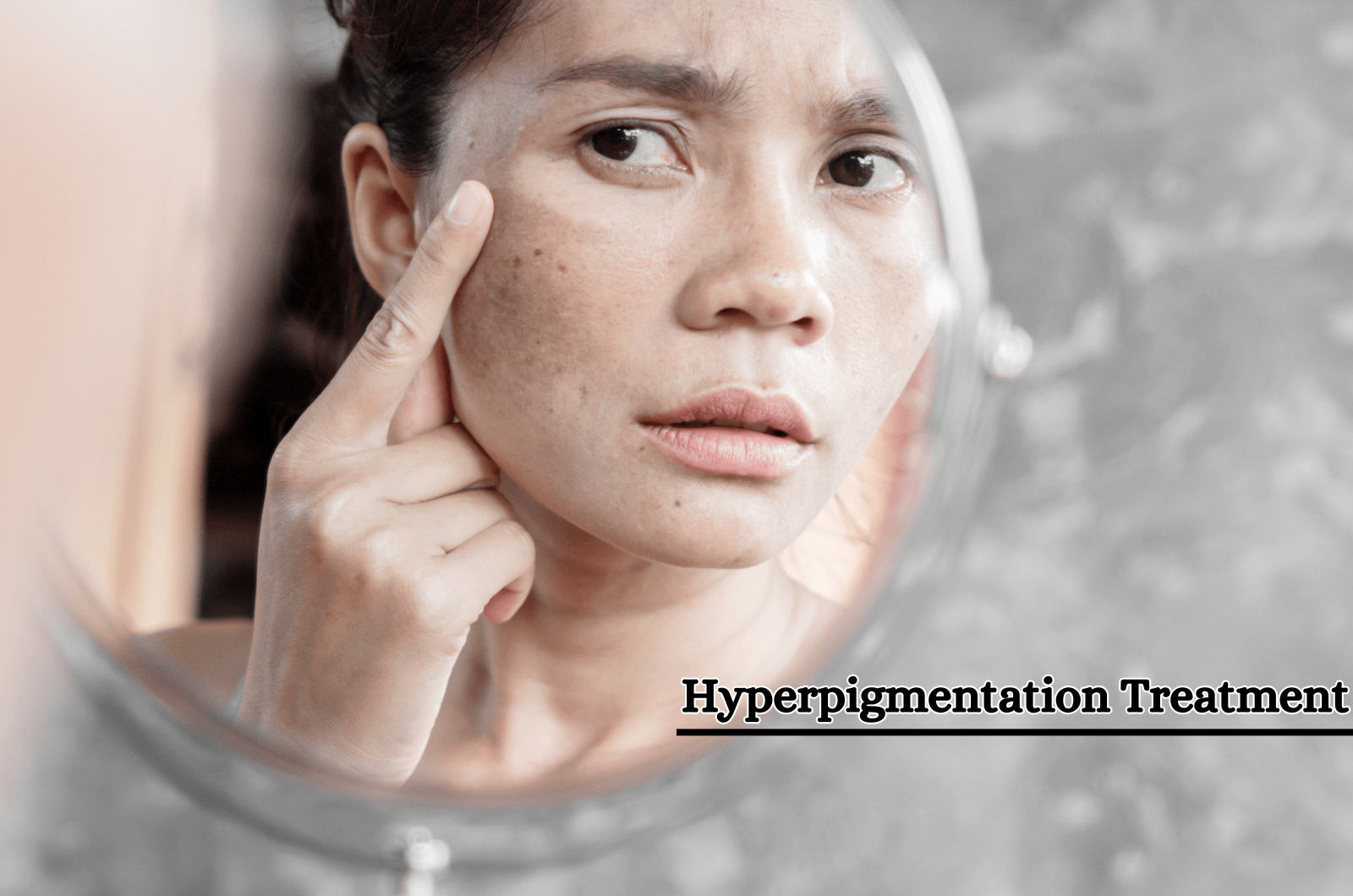 Hyperpigmentation Treatment in Bangladesh