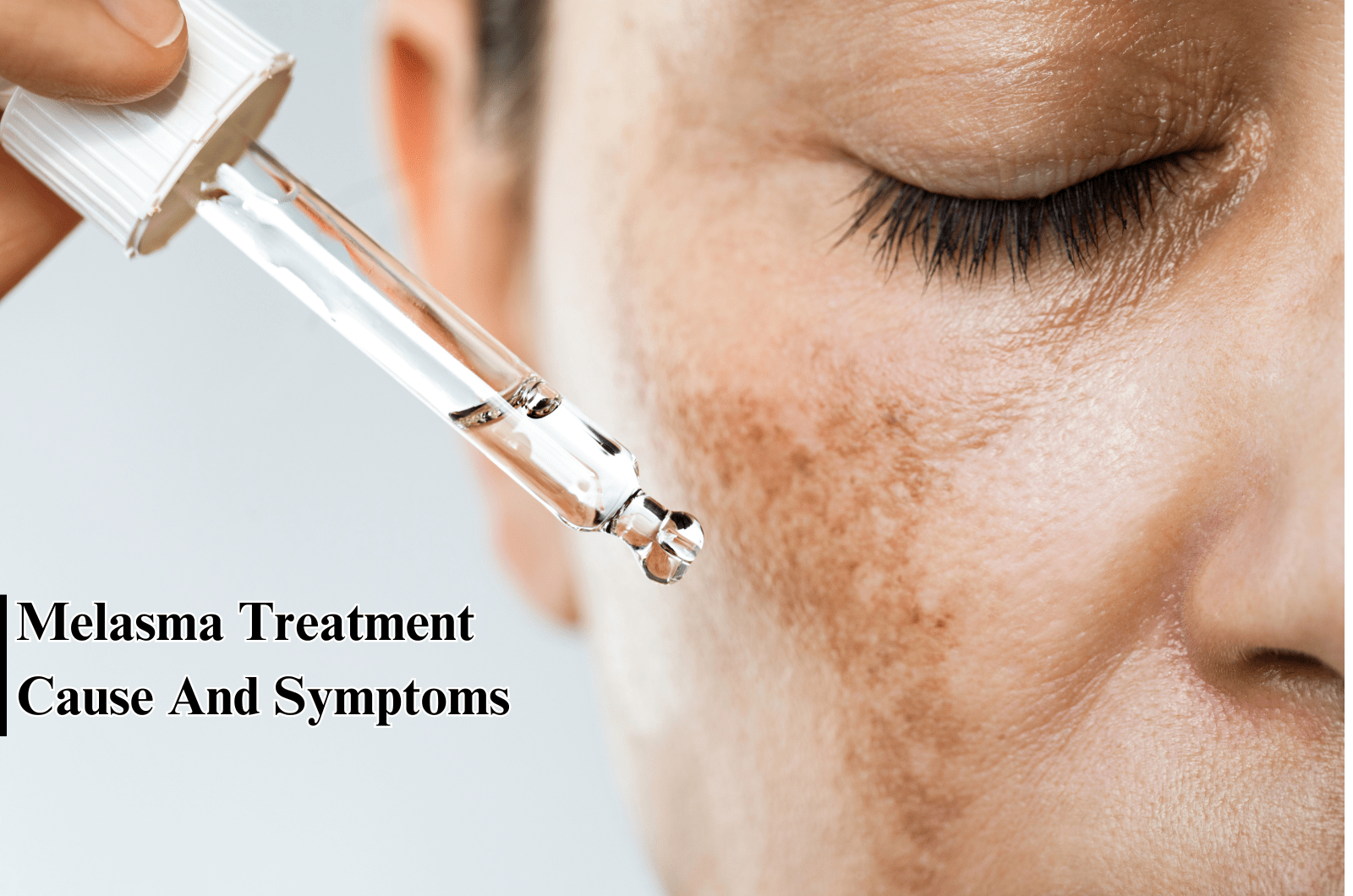 Melasma Treatment: Cause And Symptoms