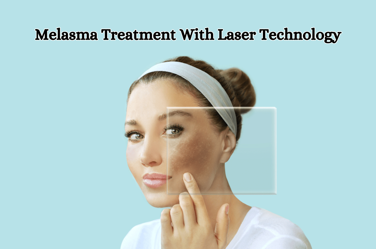 Melasma Treatment With Laser Technology