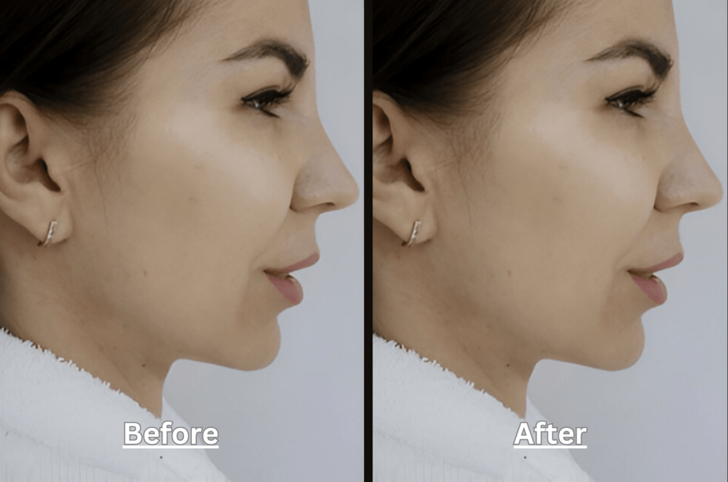 Natural Looking Lip Filler Treatment before and after