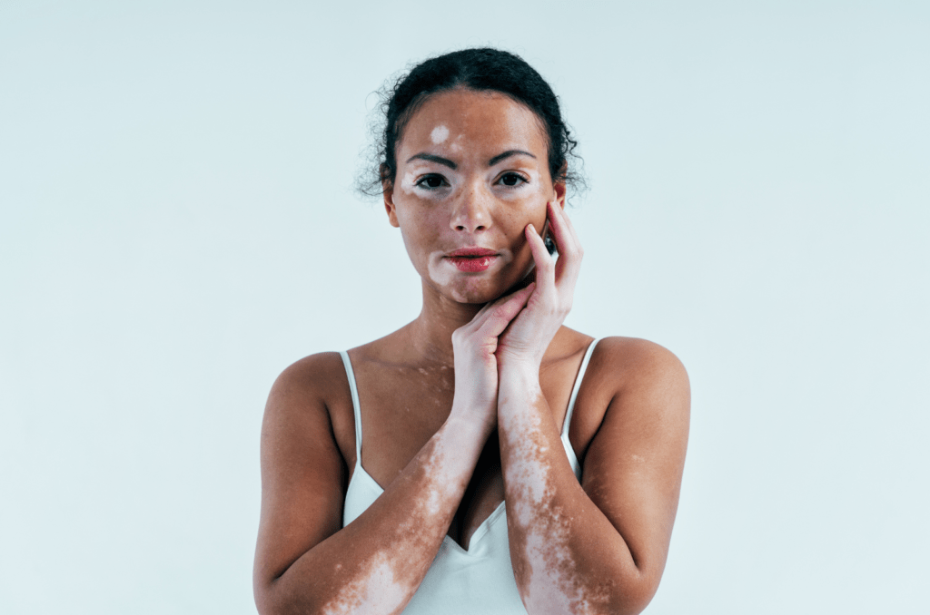 Vitiligo treatment in bangladesh