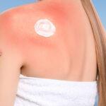 Best Skin Sunburn Treatment in Bangladesh